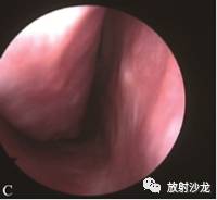 【病例】鼻结石伴真菌感染2例CT 【病例】鼻结石伴真菌感染2例CT
