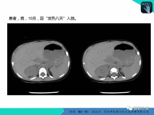 【病例】肾脓肿1例CT影像表现