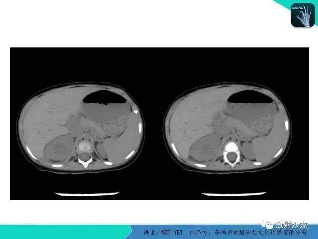 【病例】肾脓肿1例CT影像表现 【病例】肾脓肿1例CT影像表现