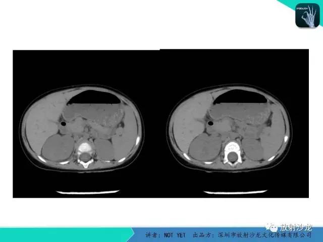 【病例】肾脓肿1例CT影像表现 【病例】肾脓肿1例CT影像表现