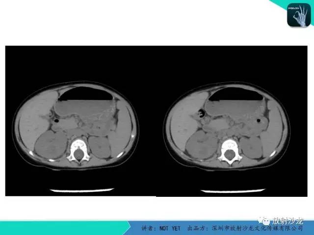 【病例】肾脓肿1例CT影像表现 【病例】肾脓肿1例CT影像表现