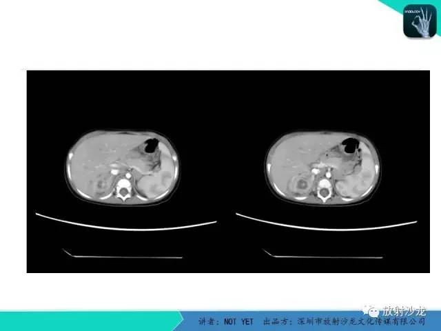 【病例】肾脓肿1例CT影像表现 【病例】肾脓肿1例CT影像表现