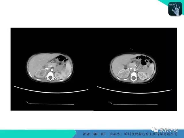 【病例】肾脓肿1例CT影像表现 【病例】肾脓肿1例CT影像表现