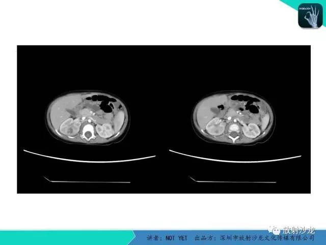 【病例】肾脓肿1例CT影像表现 【病例】肾脓肿1例CT影像表现