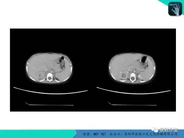 【病例】肾脓肿1例CT影像表现 【病例】肾脓肿1例CT影像表现