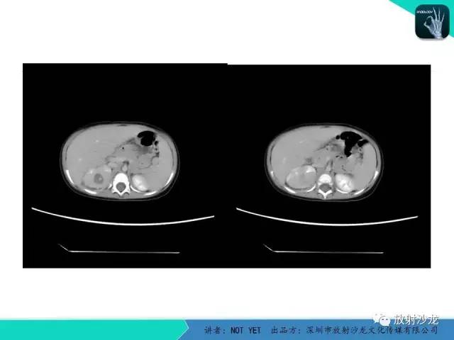 【病例】肾脓肿1例CT影像表现 【病例】肾脓肿1例CT影像表现