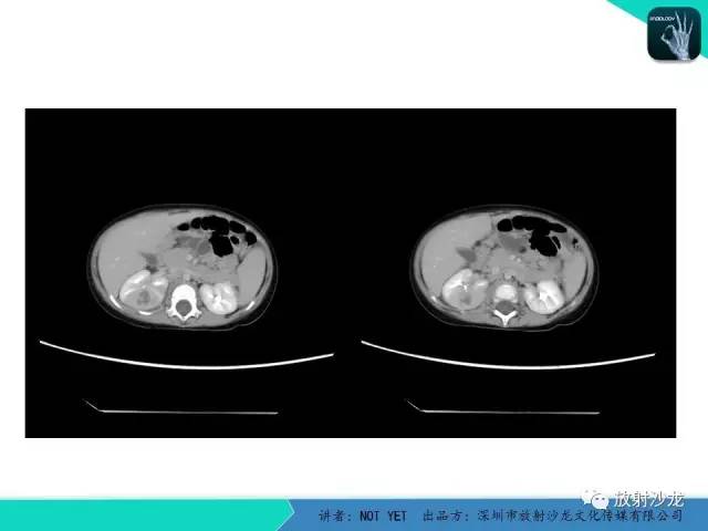 【病例】肾脓肿1例CT影像表现 【病例】肾脓肿1例CT影像表现