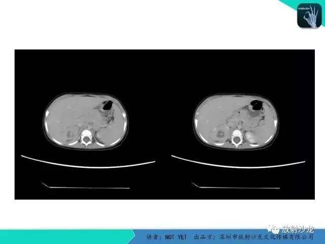 【病例】肾脓肿1例CT影像表现 【病例】肾脓肿1例CT影像表现