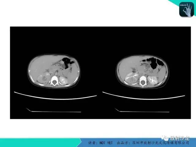 【病例】肾脓肿1例CT影像表现 【病例】肾脓肿1例CT影像表现