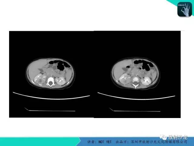 【病例】肾脓肿1例CT影像表现 【病例】肾脓肿1例CT影像表现