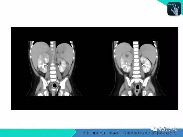 【病例】肾脓肿1例CT影像表现 【病例】肾脓肿1例CT影像表现