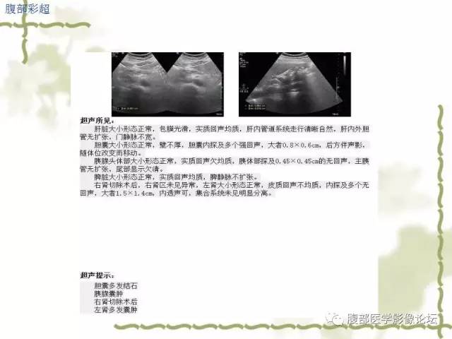 【病例】VHL希佩尔·林道综合征1例MR 【病例】VHL希佩尔·林道综合征1例MR