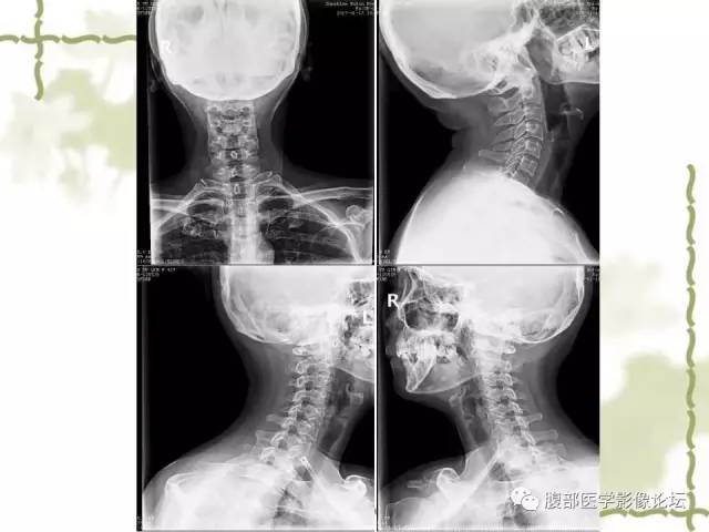 【病例】VHL希佩尔·林道综合征1例MR 【病例】VHL希佩尔·林道综合征1例MR