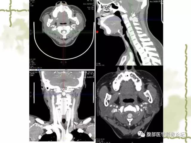 【病例】VHL希佩尔·林道综合征1例MR