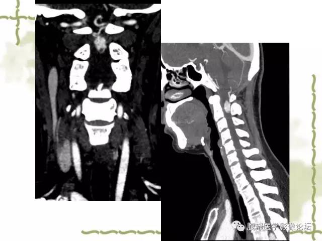 【病例】VHL希佩尔·林道综合征1例MR 【病例】VHL希佩尔·林道综合征1例MR