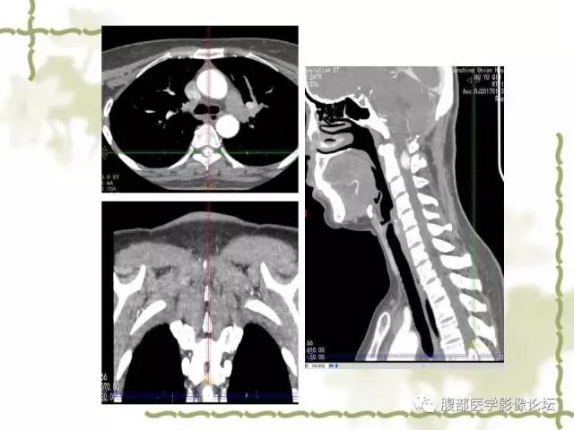 【病例】VHL希佩尔·林道综合征1例MR 【病例】VHL希佩尔·林道综合征1例MR