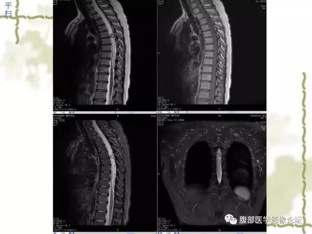 【病例】VHL希佩尔·林道综合征1例MR 【病例】VHL希佩尔·林道综合征1例MR
