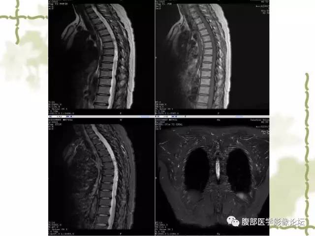 【病例】VHL希佩尔·林道综合征1例MR 【病例】VHL希佩尔·林道综合征1例MR