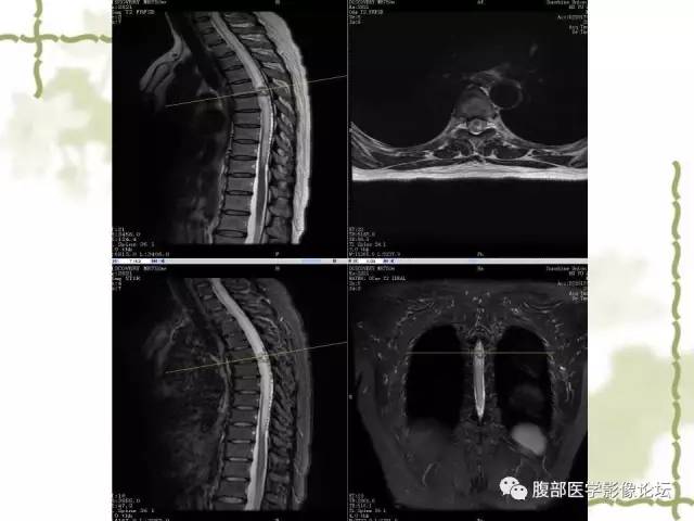 【病例】VHL希佩尔·林道综合征1例MR 【病例】VHL希佩尔·林道综合征1例MR