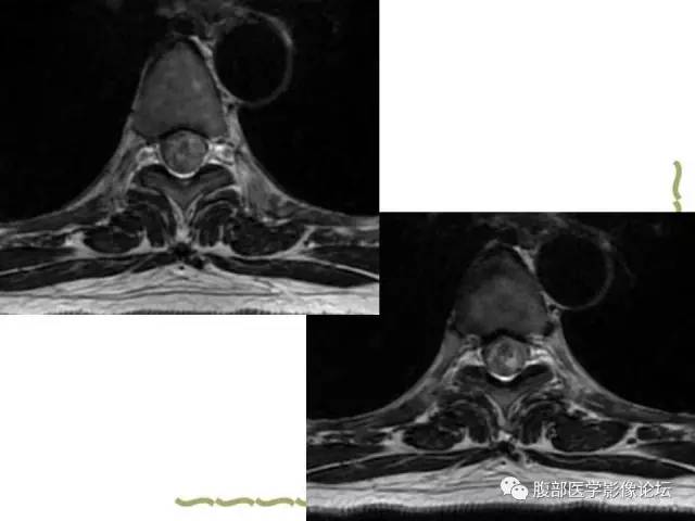 【病例】VHL希佩尔·林道综合征1例MR 【病例】VHL希佩尔·林道综合征1例MR