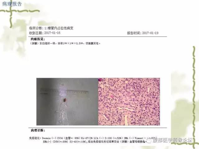 【病例】VHL希佩尔·林道综合征1例MR 【病例】VHL希佩尔·林道综合征1例MR