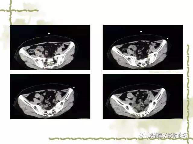 【病例】阑尾粘液性囊腺瘤1例CT 【病例】阑尾粘液性囊腺瘤1例CT