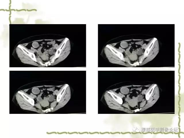 【病例】阑尾粘液性囊腺瘤1例CT 【病例】阑尾粘液性囊腺瘤1例CT