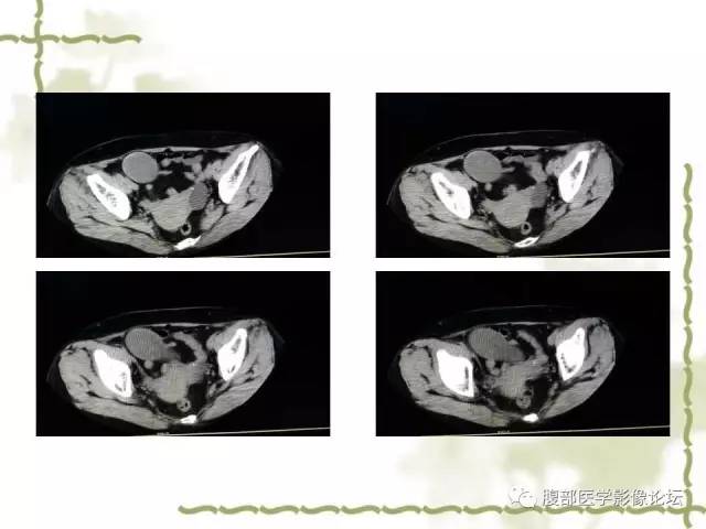 【病例】阑尾粘液性囊腺瘤1例CT 【病例】阑尾粘液性囊腺瘤1例CT