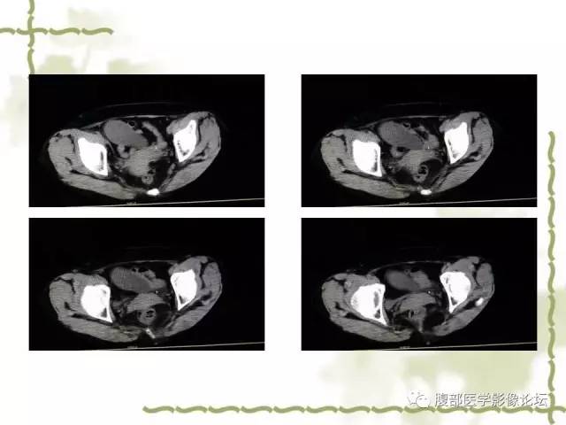 【病例】阑尾粘液性囊腺瘤1例CT 【病例】阑尾粘液性囊腺瘤1例CT