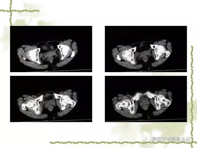 【病例】阑尾粘液性囊腺瘤1例CT 【病例】阑尾粘液性囊腺瘤1例CT
