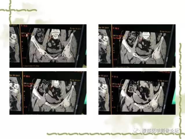 【病例】阑尾粘液性囊腺瘤1例CT 【病例】阑尾粘液性囊腺瘤1例CT