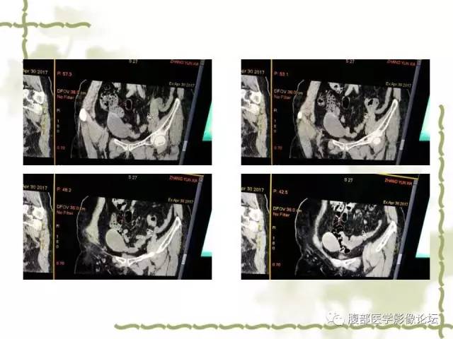 【病例】阑尾粘液性囊腺瘤1例CT 【病例】阑尾粘液性囊腺瘤1例CT