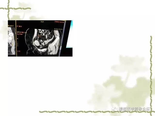【病例】阑尾粘液性囊腺瘤1例CT 【病例】阑尾粘液性囊腺瘤1例CT