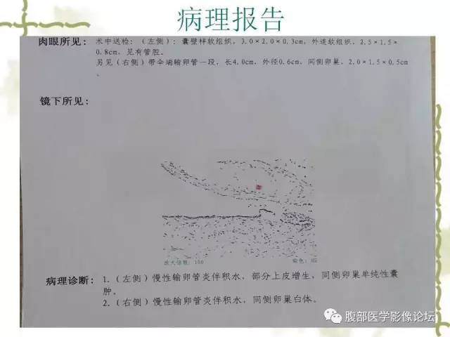【病例】阑尾粘液性囊腺瘤1例CT 【病例】阑尾粘液性囊腺瘤1例CT