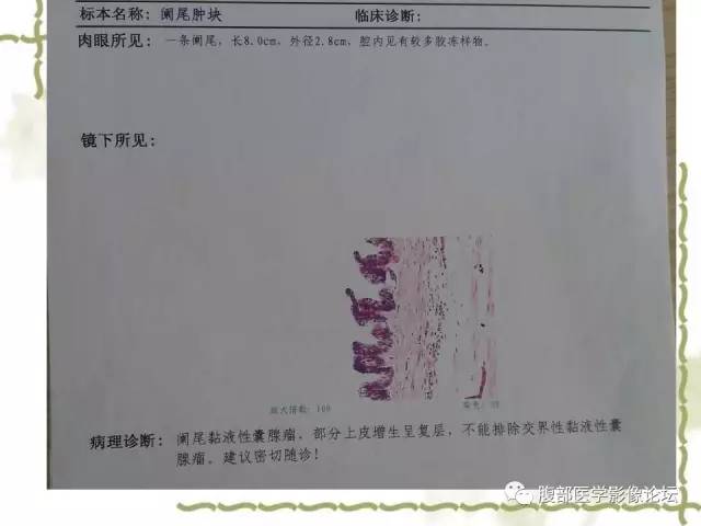 【病例】阑尾粘液性囊腺瘤1例CT 【病例】阑尾粘液性囊腺瘤1例CT