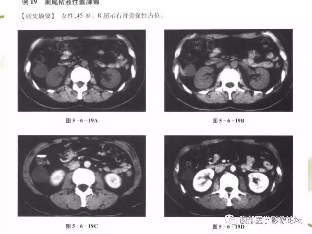 【病例】阑尾粘液性囊腺瘤1例CT 【病例】阑尾粘液性囊腺瘤1例CT