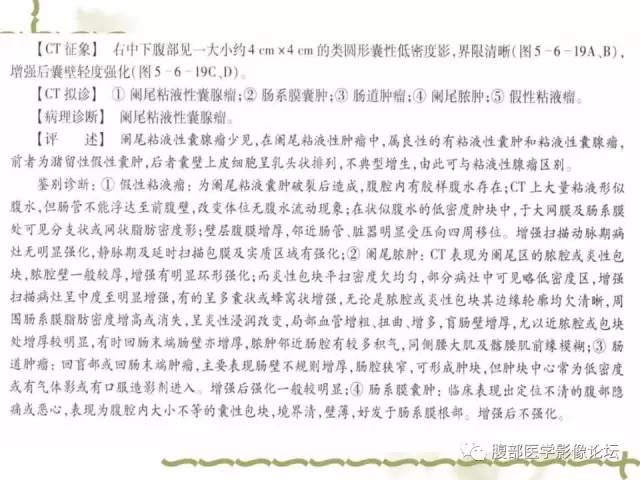 【病例】阑尾粘液性囊腺瘤1例CT 【病例】阑尾粘液性囊腺瘤1例CT