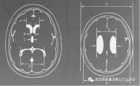 如何鉴别脑萎缩? 如何鉴别脑萎缩?