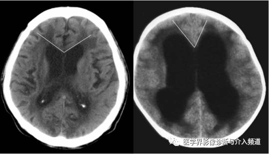 如何鉴别脑萎缩? 如何鉴别脑萎缩?