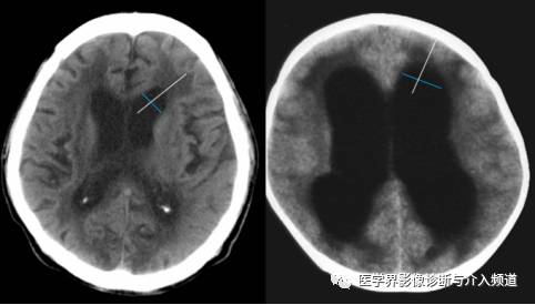 如何鉴别脑萎缩? 如何鉴别脑萎缩?