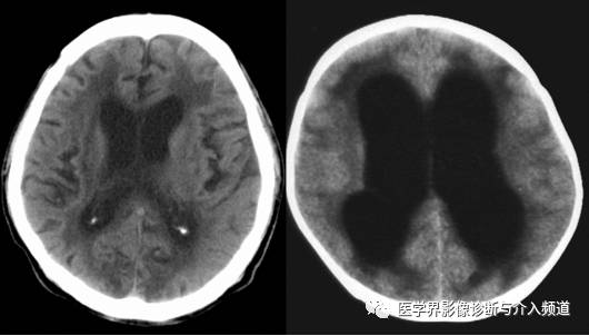 如何鉴别脑萎缩? 如何鉴别脑萎缩?