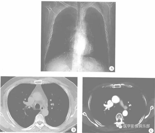 【病例】肺静脉异位引流1例CT
