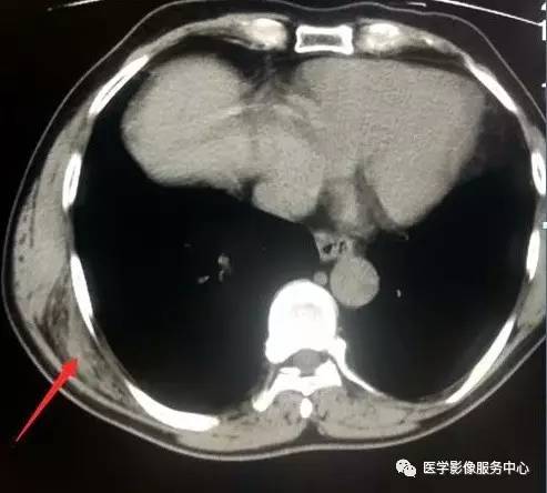 【病例】胸壁弹力纤维瘤2例CT影像表现 【病例】胸壁弹力纤维瘤2例CT影像表现