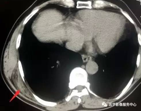 【病例】胸壁弹力纤维瘤2例CT影像表现 【病例】胸壁弹力纤维瘤2例CT影像表现