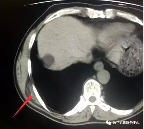 【病例】胸壁弹力纤维瘤2例CT影像表现