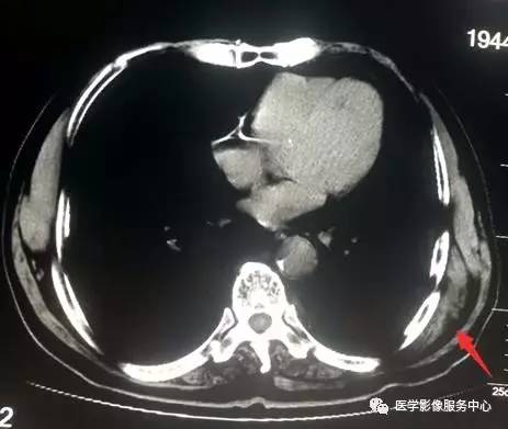 【病例】胸壁弹力纤维瘤2例CT影像表现 【病例】胸壁弹力纤维瘤2例CT影像表现