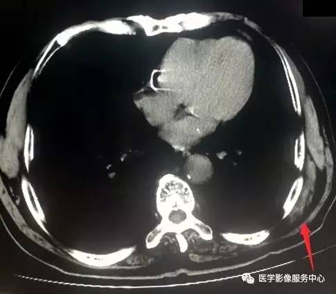 【病例】胸壁弹力纤维瘤2例CT影像表现 【病例】胸壁弹力纤维瘤2例CT影像表现