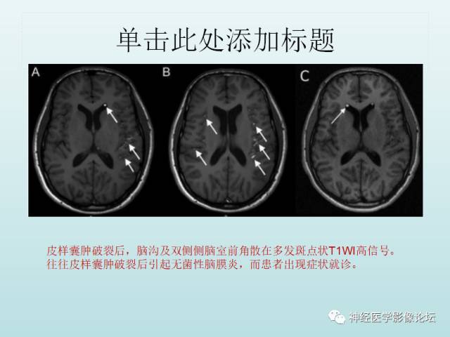 【PPT】颅内T1WI高信号病变汇总