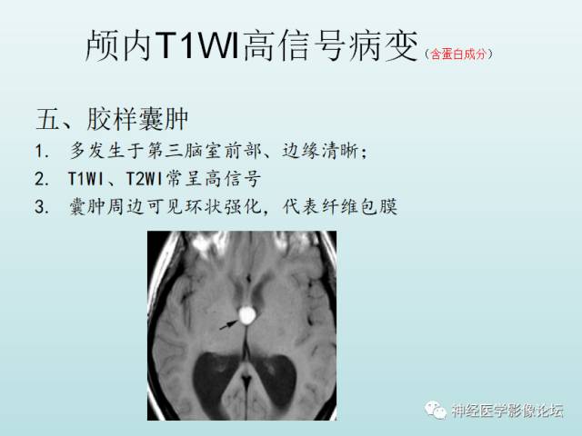 【PPT】颅内T1WI高信号病变汇总