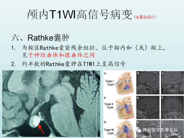【PPT】颅内T1WI高信号病变汇总